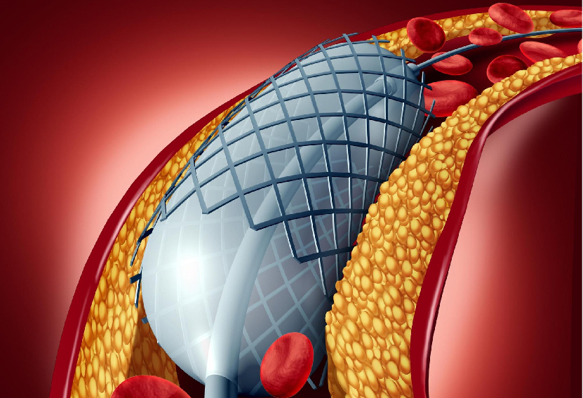 Angiography vs Angioplasty: What is the difference?